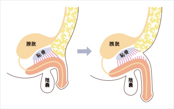14年間で7500症例以上の実績を誇る長茎術