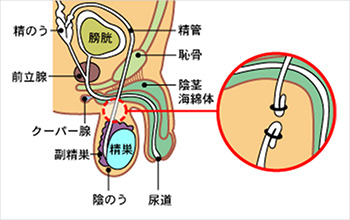 パイプカットとは