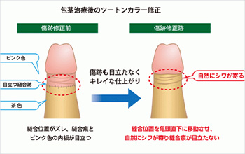 糖尿病型包茎とは